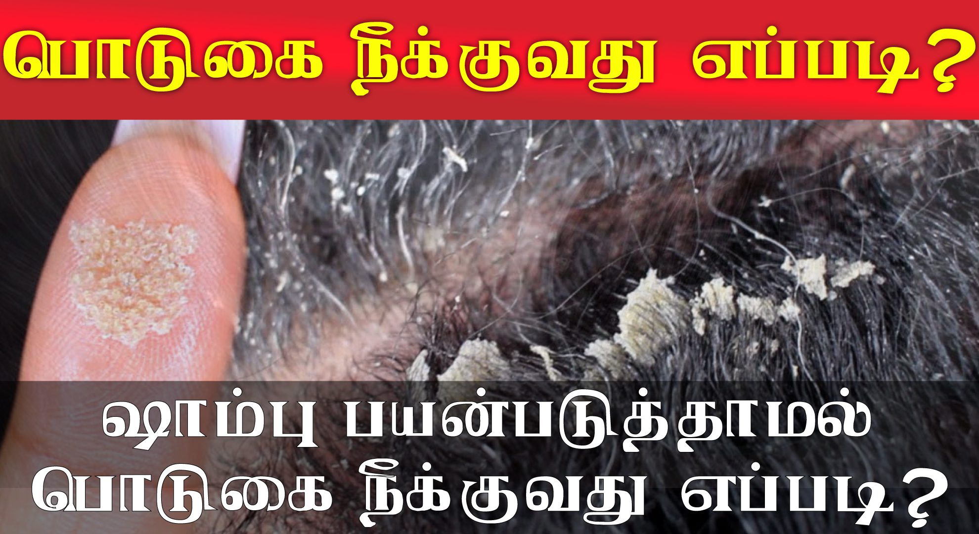 Remove dandruff without using shampoo அறிவியல்புரம்