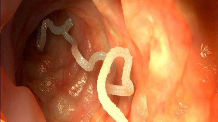 700 tapeworms spread to the brain of a person who eats uncooked meat
