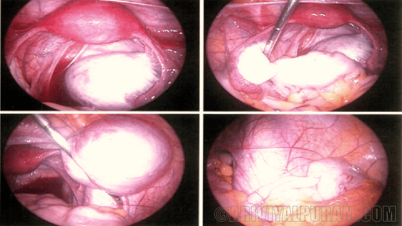 The antibody injection help people with endometriosis