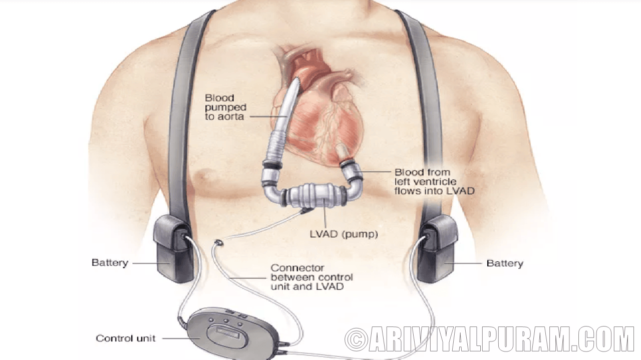 The reconstructed hearts can transplanted