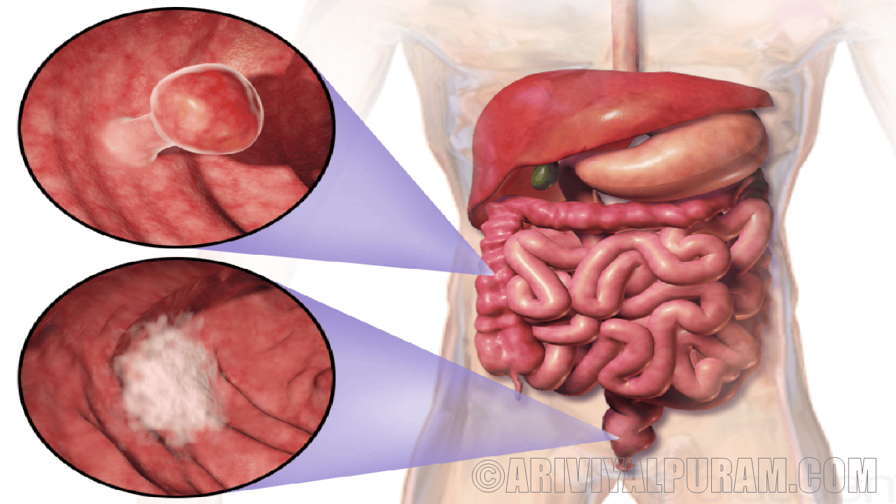 The patients with colon cancer