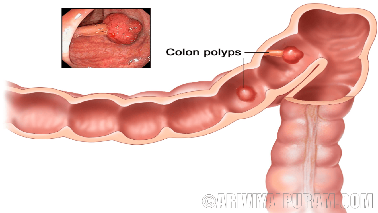 The patients with colon cancer